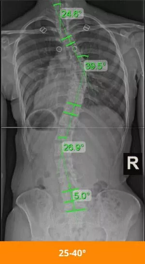 moderate-scoliosis-xray