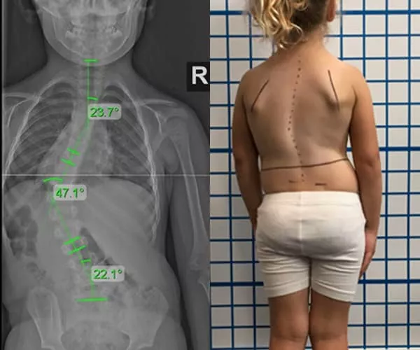 adol-pre-xray-and-posture