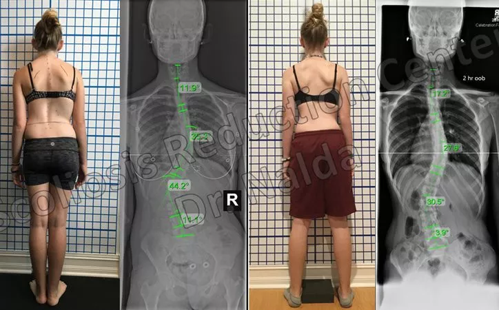 adolescent-mod-scoliosis-2