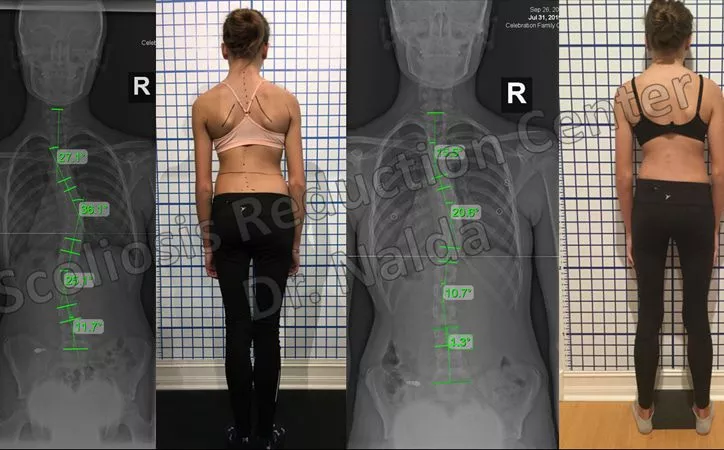 adolescent-mod-scoliosis-3