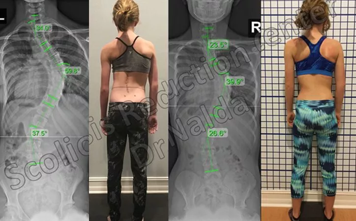 adolescent-severe-scoliosis-2