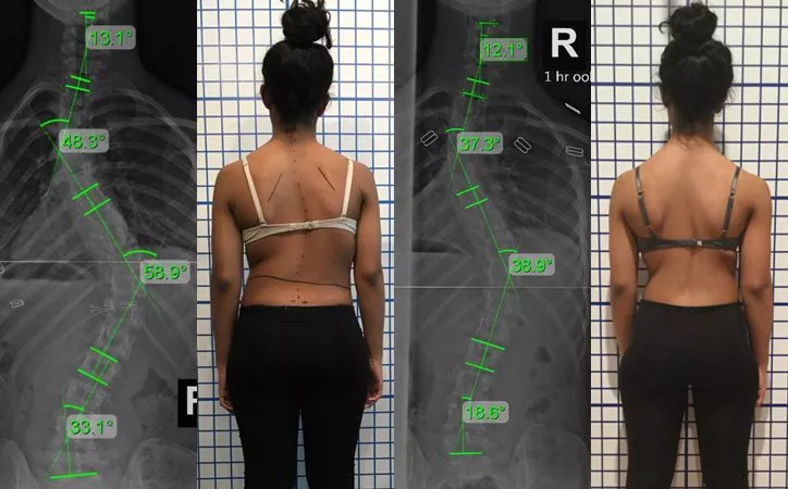 adolescent severe scoliosis 4 adolescent severe scoliosis 4