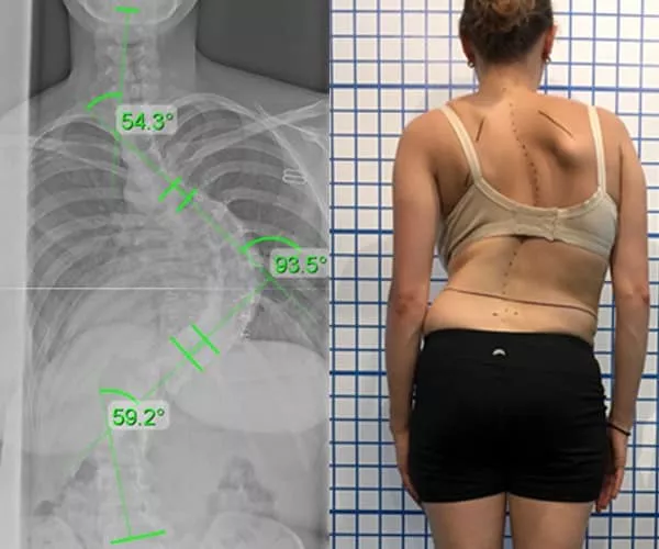 adult-pre-xray-and-posture-1