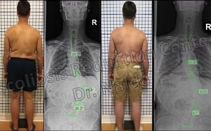 adult-severe-scoliosis-2