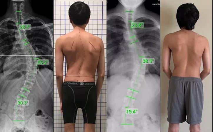 adult severe scoliosis 4 adult severe scoliosis 4
