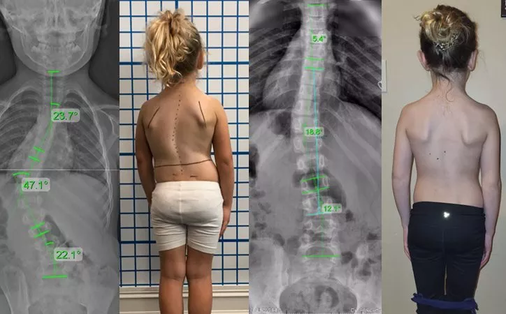 juvenile severe scoliosis 1 juvenile severe scoliosis 1