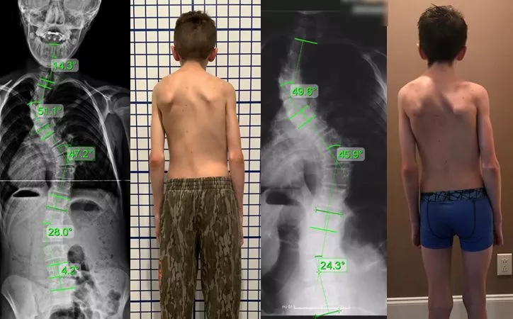 juvenile severe scoliosis 4 juvenile severe scoliosis 4