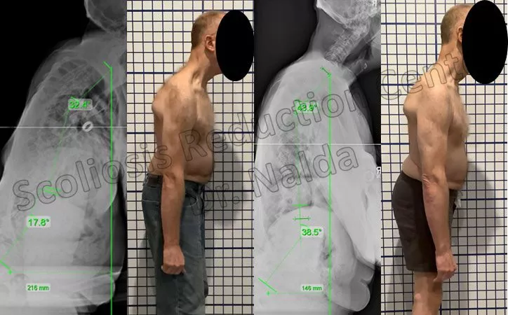 kyhosis-treatment-3