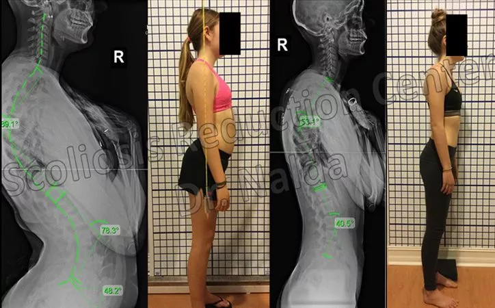 kyphosis-treatment-results-1
