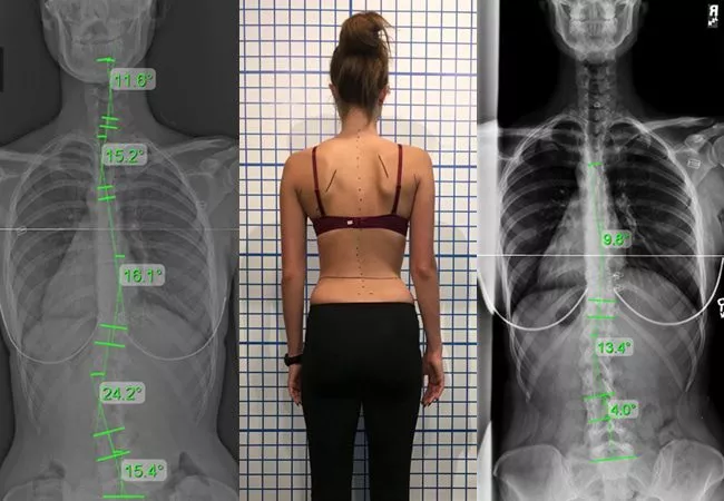 mild-scoliosis-xrays