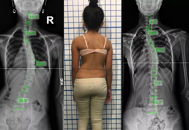 moderate-scoliosis-xrays