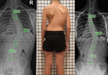 our results scoliosis xrays