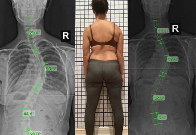 severe-scoliosis-xrays