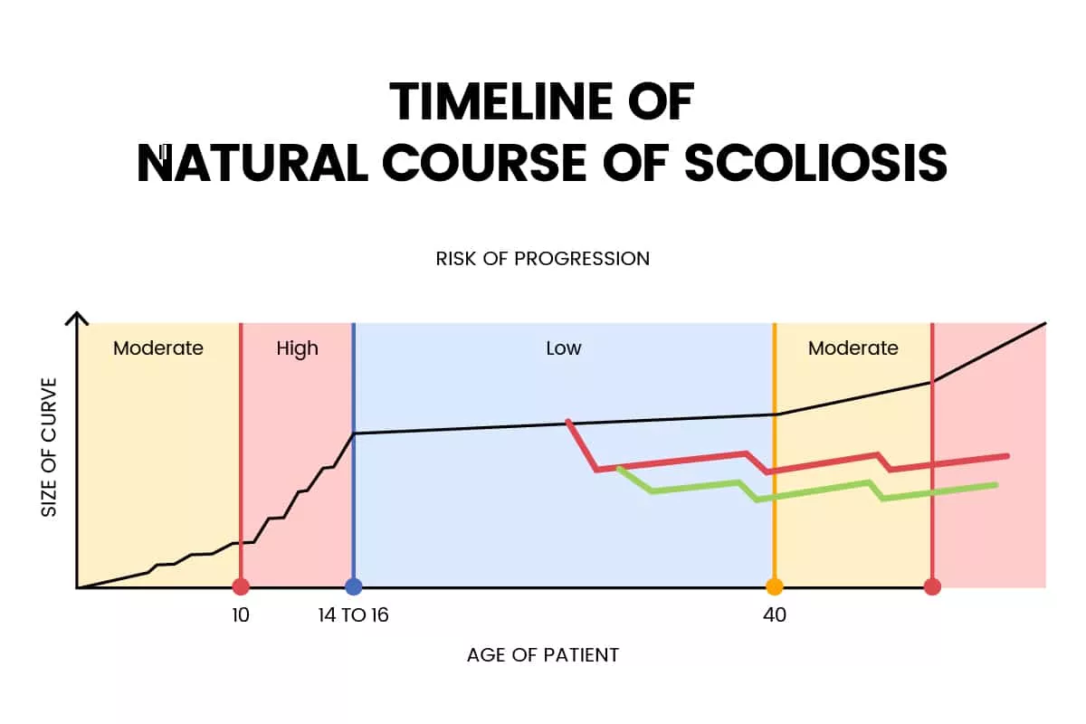 Alternate Progression Model for Adults with Adolescent Scoliosis Alternate Progression Model for Adults with Adolescent Scoliosis