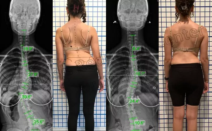 adolescent moderate lumbar 1 adolescent moderate lumbar 1