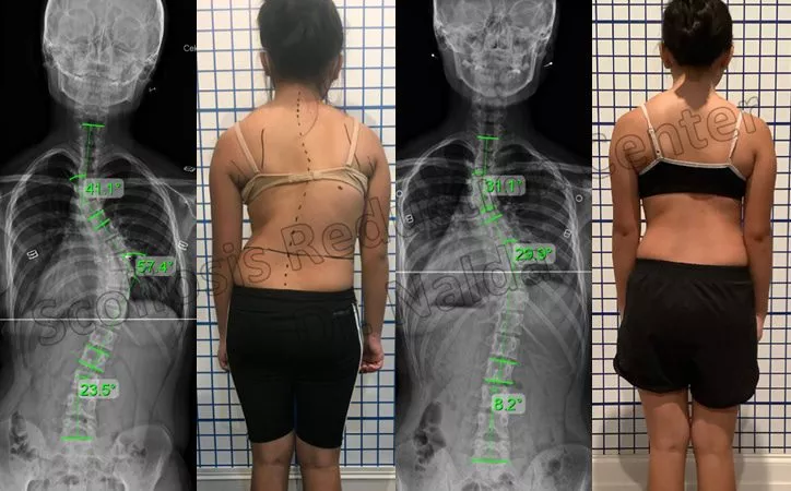 adolescent moderate lumbar 2 adolescent moderate lumbar 2