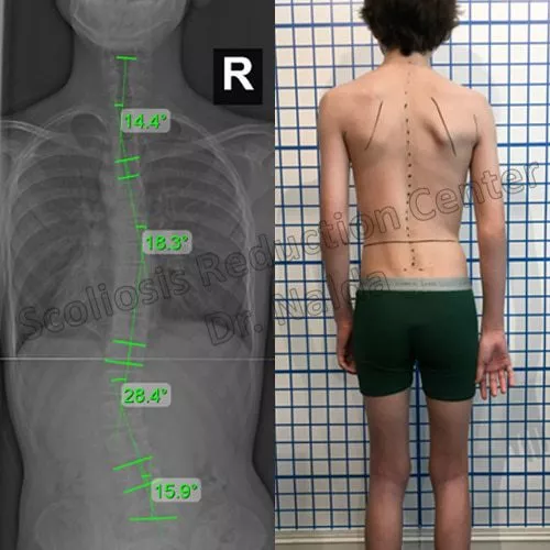 adolescent neuromuscular adolescent neuromuscular