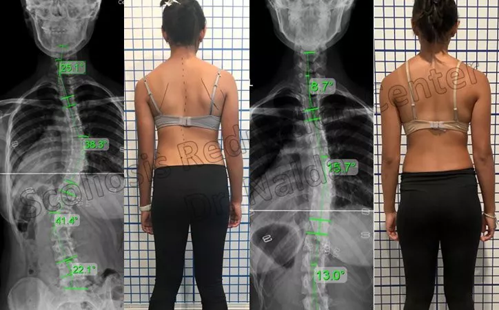 adolescent severe lumbar 1 adolescent severe lumbar 1