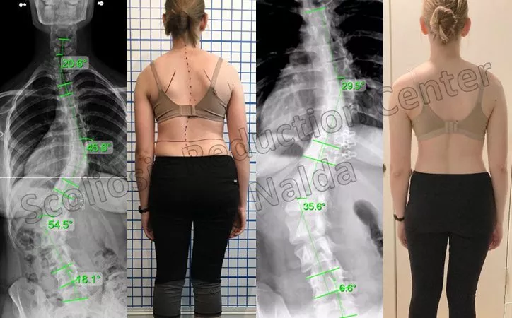 adult severe lumbar 1 adult severe lumbar 1