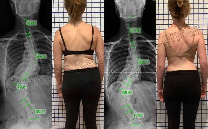 adult severe lumbar 2 adult severe lumbar 2