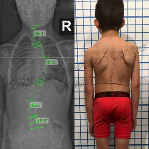 juvenile congenital juvenile congenital