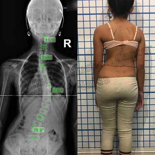 juvenile idiopathic juvenile idiopathic