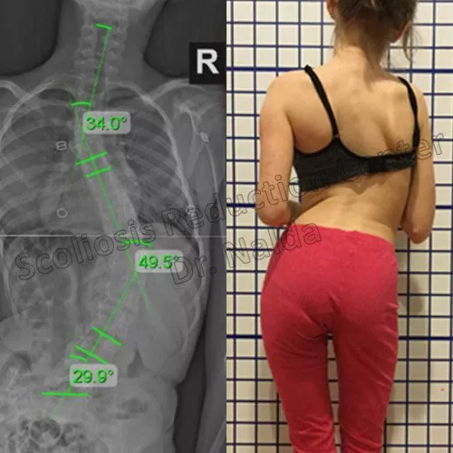 juvenile neuromuscular juvenile neuromuscular